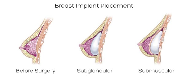 Breast implant