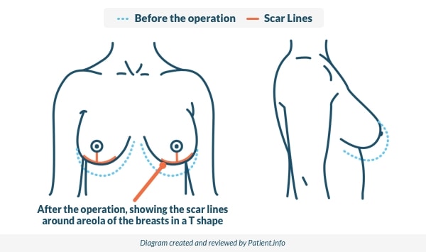 Breast Reduction in iran