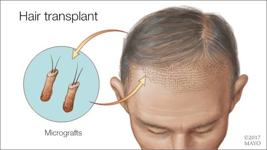 Hair Transplant in Iran