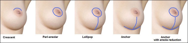 breast implant