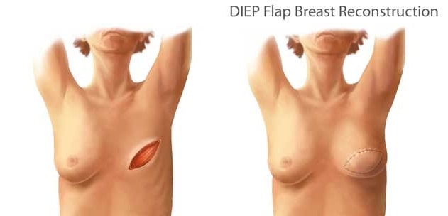 Breast Reconstruction in iran