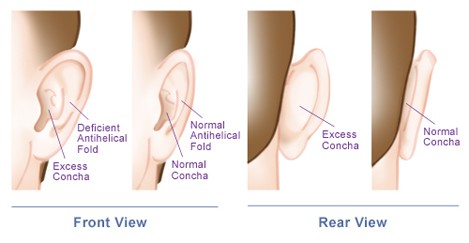 ear surgery