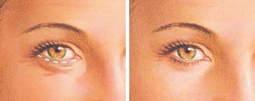 Blepharoplasty 