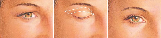 eyelid surgery in Iran