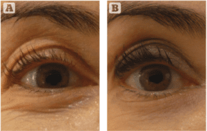 plasma eye lift before and after