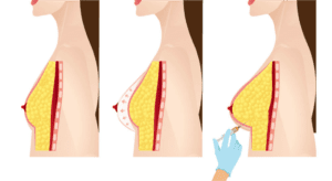 fat transfer to breast 