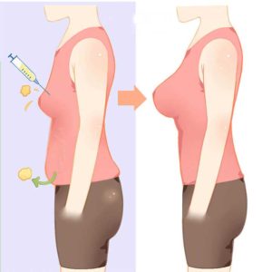 fat transfer breast augmentation